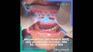 දත් පෙළක් නවීන Invisalign මඟින්මාස 7 න් හරියාකාරව නිවැරදි කිරීම [upl. by Rosmarin945]