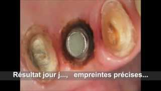 PHILIPS LASERS Décapuchonnage implants 3wmv [upl. by Ysiad]