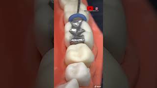 ¡🔥Instalación de separadores dentales y bandas metálicas en las muelas 0🦷0🔥 [upl. by Piegari]