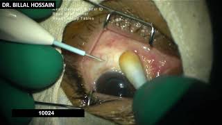 Ozurdex intravitreal injection for Persistent macular edema due to chronic uveitis by Dr Billal [upl. by Ettellocin]