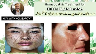 homeopathic medicines for freckles on face homeopathy treatment for melasma freckles removal cream [upl. by Adnuhsal444]