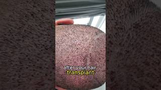 scabbing after a hair transplant hairloss scabbing hairtransplant [upl. by Gambrill]