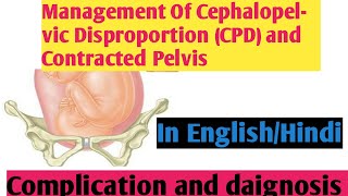 Management Of Cephalopelvic Disproportion CPD amp Contracted Pelvis II Nightingale Nursing Nursing [upl. by Arita607]