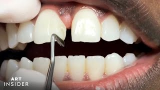 How Tooth Gaps Are Filled  Insider Art [upl. by Ilsa]