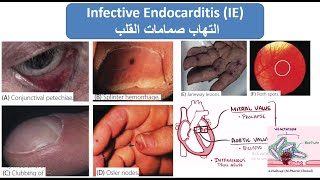 Infective Endocarditis إلتهاب صمامات القلب [upl. by Skipp]