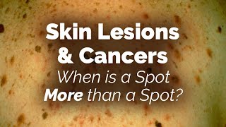 When is a Spot More than a Spot Skin Lesions and Cancers [upl. by Urita]