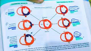 Myocardial Infarction pathologyAnterior wall MISTEMI AND NSTEMIHeart pathologyRobbins pathology [upl. by Atiluj330]