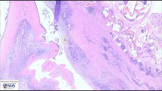 Pancreas Mucinous cystic neoplasm  Microscopy Talking slide [upl. by Borras699]