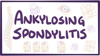 Ankylosing spondylitis  causes symptoms diagnosis treatment pathology [upl. by Vaientina585]