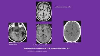 Neurology Quiz 20 Topics Neurocysticercosis NCC and drug induced myopathies [upl. by Ailhat781]