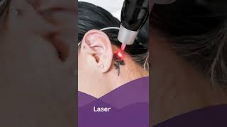 Laser Tattoo Removal amp Skin Treatments in Surat Gujarat  Callisto Clinic by Dr Rushin Thakor [upl. by Auhsoj53]