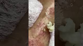 Satisfying Blackhead Removal Clear Skin Transformation Part 26 [upl. by Nahtanoj]