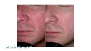 FDAApproved LaViv Fibroblast Treatment  Maryland Laser Skin amp Vein [upl. by Eustashe164]