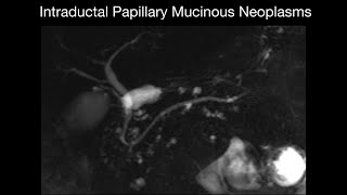 Intraductal Papillary Mucinous Neoplasms [upl. by Eeliab]