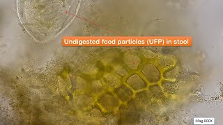 Undigested food particles in faeces Microscopy at 400X and 800X [upl. by Suoiluj]