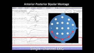 Introduction to EEG [upl. by Hyacinthe141]