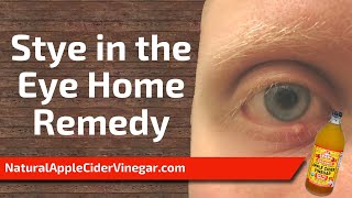 The Best Home Remedy for Stye In The Eye [upl. by Madge614]