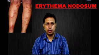 Erythema Nodosum Important Points causes  symptoms  investigations  treatment [upl. by Llirred]