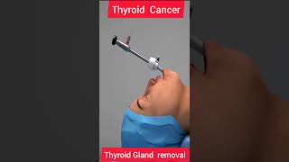 THYROID CANCER  THYROID REMOVAL 3D ANIMATION biologyislife howtogetsuccessinlife getsuccess [upl. by Hayyifas]