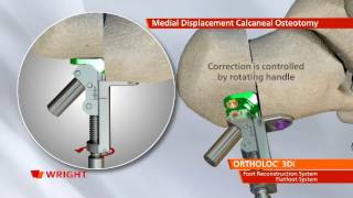 Wright  Ortholoc 3DI Flatfoot System [upl. by Stefa593]