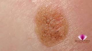 Melanoma Pictures  Signs Symptoms Causes Photos Images Pictures of Melanoma Skin Cancer [upl. by Heidy190]