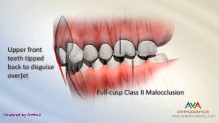 Malocclusion  Class II Div 2 [upl. by Giulietta]