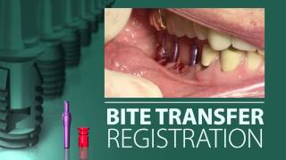 Implant Level Impression and Bite Registration [upl. by Bride340]