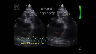 Paroxysmal supraventricular tachycardia  Tachycardie paroxystique supraventriculaire [upl. by Annoit709]