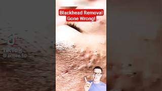 TERRIBLE BLACKHEAD REMOVAL  Shocked At This One shorts [upl. by Akcimehs]