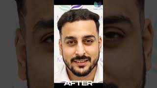 💥Unbelievable Hair Transplant Results MedLinksHairTransplants  shorts shortsfeed viral [upl. by Esinwahs]