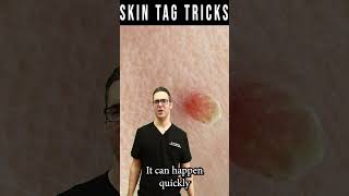 Skin Tag Removal amp Plantar Wart Removal Garlic Iodine amp Cider [upl. by Orihakat]