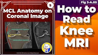 Fig 3A05 Medial Collateral Ligament Anatomy Knee MRI coronal and axial images [upl. by Fernandez105]