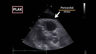 Pericardial Effusion with Doppler Echocardiographic criteria for Tamponade [upl. by Aloisius]