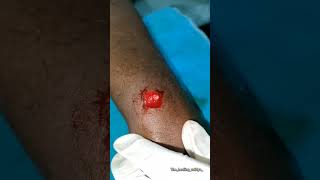 Papilloma surgery with agnikarma papillomaagnikarmaayurvedaforall [upl. by Airtap]