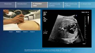 Key screening views of the fetal heart  Part 3  4chamber view [upl. by Marb]