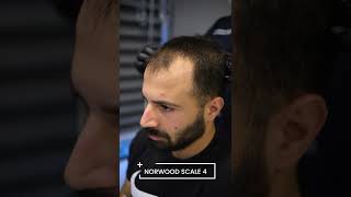 Hair Loss Types  Norwood Scale  Hair Transplant Turkey [upl. by Dallas]