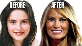 Melania Trumps Plastic Surgery Secrets Exposed 2024 [upl. by Sajovich777]