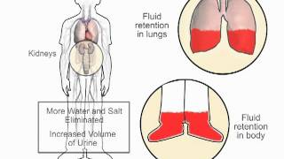 How diuretics work in heart failure  wwwheartfailuremattersorg [upl. by Aicert]