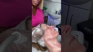 RF Skin Tightening Treatment Proceedure [upl. by Anitnerolf]