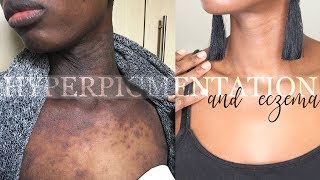 HEALING ECZEMA AND HYPERPIGMENTATION QampA WITH BEFORE AND AFTER [upl. by Nnylirej]