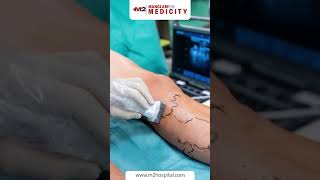 Can Varicose Veins Return After Treatment [upl. by Anagnos129]