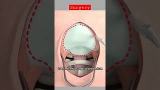 Craniectomy surgical procedure shorts neet doctor [upl. by Greenleaf665]