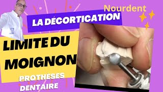 la décortication de la limite du moignon prothèse dentaire [upl. by Enia]