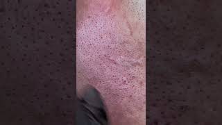 hairremoval blackhead skincare [upl. by Viva692]