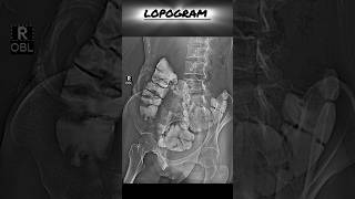 Distal Lopogram  Large bowel  cologram loogopgram [upl. by Donelson695]