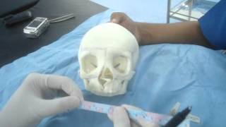 Hypertelorism correction and Box Osteotomies part 1 Dr Derick Mendonca [upl. by Files]