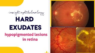 HARD EXUDATES  Hypopigmented lesions of the retina [upl. by Avitzur385]