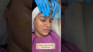 Yellow Peel Skin Lightening peelSkin Smile Clinic Bhopal ☎️ 9691918200skincare bhopal [upl. by Alroy40]