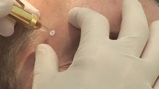 Removing warts how to [upl. by Hunsinger446]