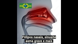 PÓLIPOS NASAIS SINUSITE alérgica VACINA alergia SUBLINGUAL ASMA GRAVE alergia CEFALEXINA e mais [upl. by Assilim819]